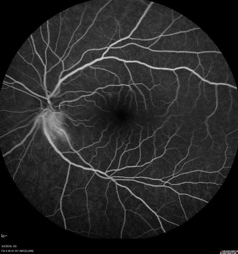 Cat Scratch - Neuroretinitis OD AND retinitis OS - Bartonella henselae positive
27 year old female with exposure to cats and prior fever.  Reports with recent vision loss right eye.  She was treated with doxycycline and within 2 weeks the right eye looks better.  Then she skipped all follow-up visits.  The right eye presented 20/200 and the left 20/16
