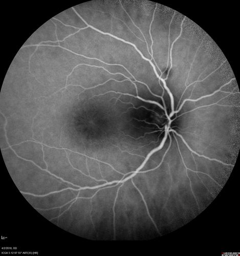 Cat Scratch - Neuroretinitis OD AND retinitis OS - Bartonella henselae positive
27 year old female with exposure to cats and prior fever.  Reports with recent vision loss right eye.  She was treated with doxycycline and within 2 weeks the right eye looks better.  Then she skipped all follow-up visits.  The right eye presented 20/200 and the left 20/16

