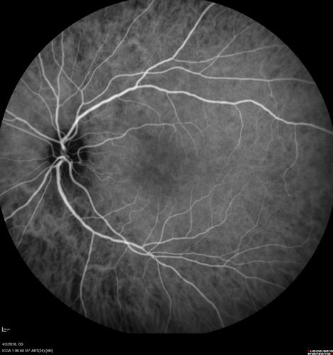 Cat Scratch - Neuroretinitis OD AND retinitis OS - Bartonella henselae positive
27 year old female with exposure to cats and prior fever.  Reports with recent vision loss right eye.  She was treated with doxycycline and within 2 weeks the right eye looks better.  Then she skipped all follow-up visits.  The right eye presented 20/200 and the left 20/16
