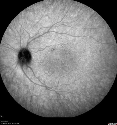 Cat Scratch - Neuroretinitis OD AND retinitis OS - Bartonella henselae positive
27 year old female with exposure to cats and prior fever.  Reports with recent vision loss right eye.  She was treated with doxycycline and within 2 weeks the right eye looks better.  Then she skipped all follow-up visits.  The right eye presented 20/200 and the left 20/16
