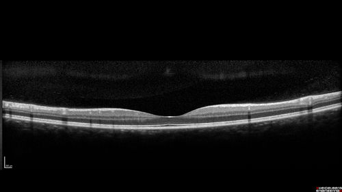 Cat Scratch - Neuroretinitis OD AND retinitis OS - Bartonella henselae positive
27 year old female with exposure to cats and prior fever.  Reports with recent vision loss right eye.  She was treated with doxycycline and within 2 weeks the right eye looks better.  Then she skipped all follow-up visits.  The right eye presented 20/200 and the left 20/16
