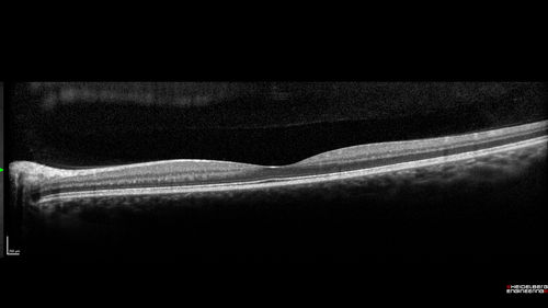 Cat Scratch - Neuroretinitis OD AND retinitis OS - Bartonella henselae positive
27 year old female with exposure to cats and prior fever.  Reports with recent vision loss right eye.  She was treated with doxycycline and within 2 weeks the right eye looks better.  Then she skipped all follow-up visits.  The right eye presented 20/200 and the left 20/16
