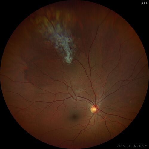 Retinal Cavernous Hemangioma
27 year old female with normal vision - MRI was normal
