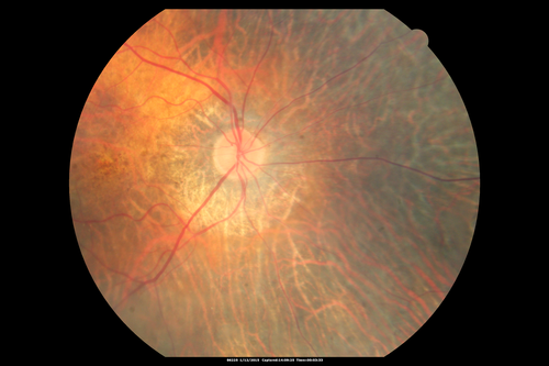 Choroideremia - Female Carrier - Patchy Atrophy of Choroid and RPE - Lyonization
