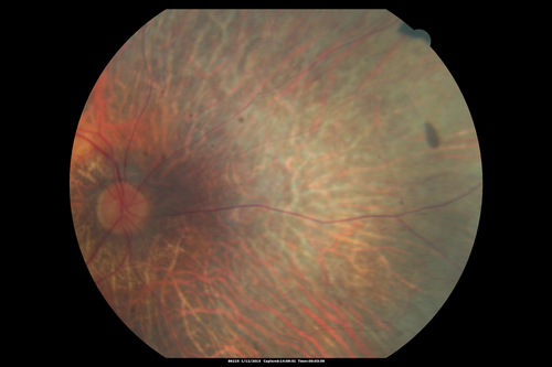 Choroideremia - Female Carrier - Patchy Atrophy of Choroid and RPE - Lyonization
