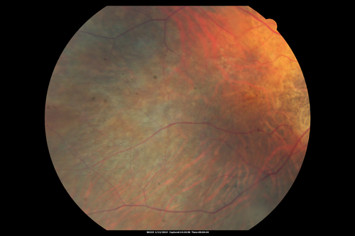 Choroideremia - Female Carrier - Patchy Atrophy of Choroid and RPE - Lyonization
