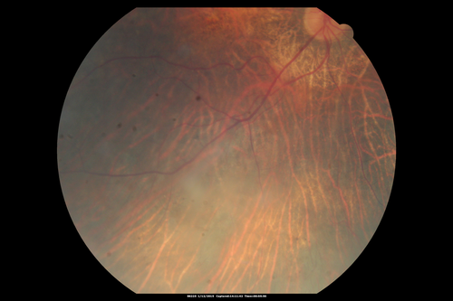 Choroideremia - Female Carrier - Patchy Atrophy of Choroid and RPE - Lyonization
