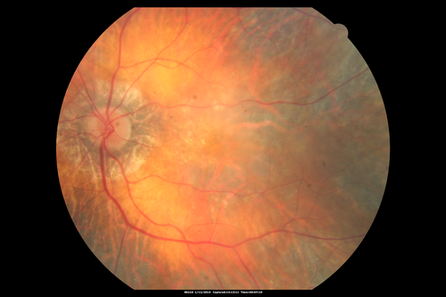 Choroideremia - Female Carrier - Patchy Atrophy of Choroid and RPE - Lyonization
