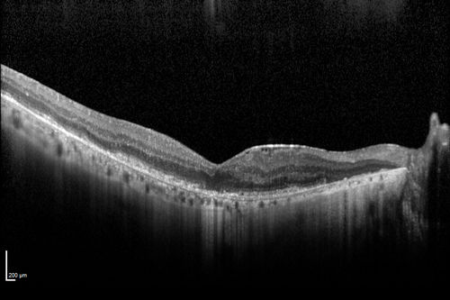 Choroideremia - Female Carrier - Patchy Atrophy of Choroid and RPE - Lyonization
