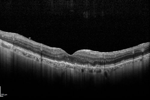 Choroideremia - Female Carrier - Patchy Atrophy of Choroid and RPE - Lyonization
