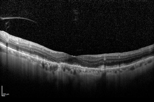 Choroideremia - Female Carrier - Patchy Atrophy of Choroid and RPE - Lyonization
