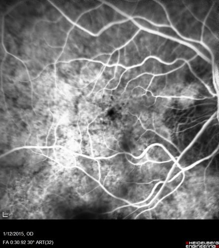Choroideremia - Female Carrier - Patchy Atrophy of Choroid and RPE - Lyonization
