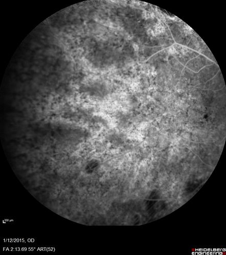 Choroideremia - Female Carrier - Patchy Atrophy of Choroid and RPE - Lyonization
