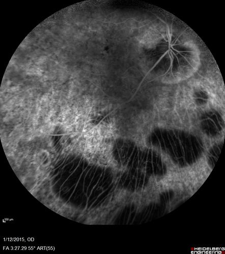 Choroideremia - Female Carrier - Patchy Atrophy of Choroid and RPE - Lyonization
