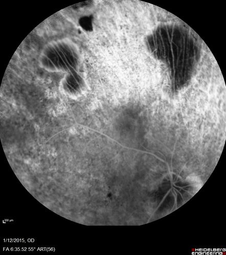 Choroideremia - Female Carrier - Patchy Atrophy of Choroid and RPE - Lyonization
