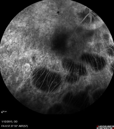 Choroideremia - Female Carrier - Patchy Atrophy of Choroid and RPE - Lyonization
