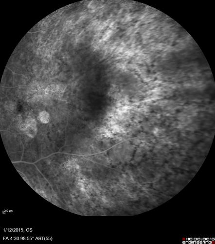 Choroideremia - Female Carrier - Patchy Atrophy of Choroid and RPE - Lyonization

