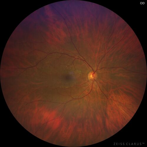 Choroidal macrovessel
70 year old female with vision loss in the left eye 4 months after cataract surgery.
VA 20/32 OD, 20/80 OS
Images show CME but also a choroidal macrovessel in the left eye.
