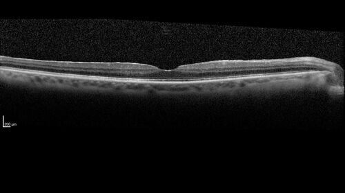 Choroidal macrovessel
70 year old female with vision loss in the left eye 4 months after cataract surgery.
VA 20/32 OD, 20/80 OS
Images show CME but also a choroidal macrovessel in the left eye.
