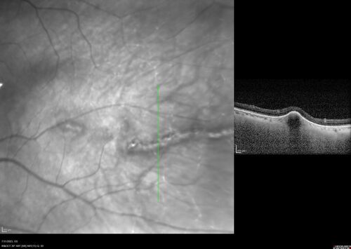 Choroidal macrovessel
70 year old female with vision loss in the left eye 4 months after cataract surgery.
VA 20/32 OD, 20/80 OS
Images show CME but also a choroidal macrovessel in the left eye.
