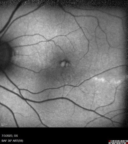 Choroidal macrovessel
70 year old female with vision loss in the left eye 4 months after cataract surgery.
VA 20/32 OD, 20/80 OS
Images show CME but also a choroidal macrovessel in the left eye.
