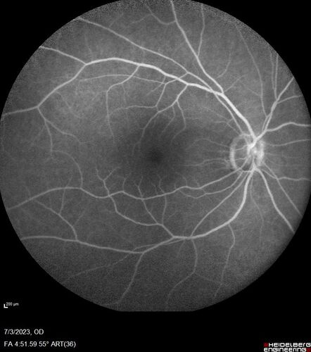 Choroidal macrovessel
70 year old female with vision loss in the left eye 4 months after cataract surgery.
VA 20/32 OD, 20/80 OS
Images show CME but also a choroidal macrovessel in the left eye.
