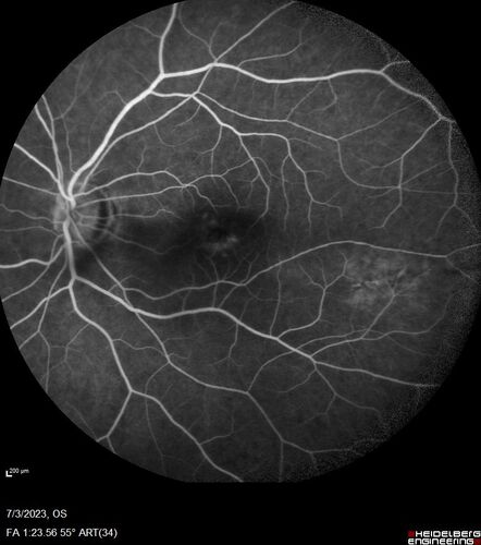 Choroidal macrovessel
70 year old female with vision loss in the left eye 4 months after cataract surgery.
VA 20/32 OD, 20/80 OS
Images show CME but also a choroidal macrovessel in the left eye.
