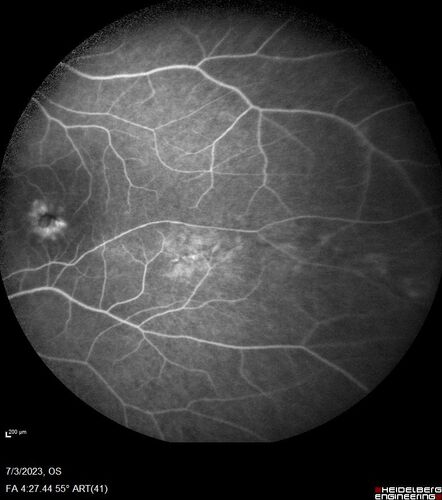 Choroidal macrovessel
70 year old female with vision loss in the left eye 4 months after cataract surgery.
VA 20/32 OD, 20/80 OS
Images show CME but also a choroidal macrovessel in the left eye.

