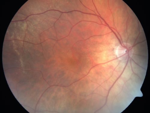 Cilioretinal artery occlusion and Ophthalmic Artery Occlusion with Relative Sparing of the Central Retinal Artery
80-year-old woman who says she was looking in the mirror, covered her right eye and noticed she could not see well out of the left eye.  That just happened yesterday.  Her last eye check was a few years ago.  She also had a carotid endarterectomy on the right side in 2006 shortly after coronary bypass surgery.  OD is 20/40, OS is 20/200.
