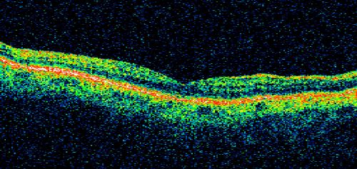 Cilioretinal artery occlusion and Ophthalmic Artery Occlusion with Relative Sparing of the Central Retinal Artery
80-year-old woman who says she was looking in the mirror, covered her right eye and noticed she could not see well out of the left eye.  That just happened yesterday.  Her last eye check was a few years ago.  She also had a carotid endarterectomy on the right side in 2006 shortly after coronary bypass surgery.  OD is 20/40, OS is 20/200.
