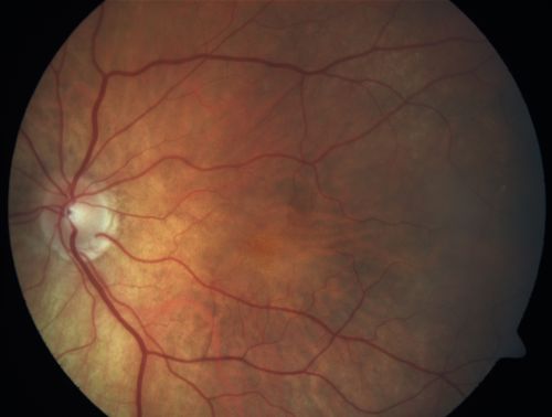 Cilioretinal artery occlusion and Ophthalmic Artery Occlusion with Relative Sparing of the Central Retinal Artery
80-year-old woman who says she was looking in the mirror, covered her right eye and noticed she could not see well out of the left eye.  That just happened yesterday.  Her last eye check was a few years ago.  She also had a carotid endarterectomy on the right side in 2006 shortly after coronary bypass surgery.  OD is 20/40, OS is 20/200.
