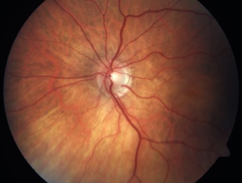 Cilioretinal artery occlusion and Ophthalmic Artery Occlusion with Relative Sparing of the Central Retinal Artery
80-year-old woman who says she was looking in the mirror, covered her right eye and noticed she could not see well out of the left eye.  That just happened yesterday.  Her last eye check was a few years ago.  She also had a carotid endarterectomy on the right side in 2006 shortly after coronary bypass surgery.  OD is 20/40, OS is 20/200.
