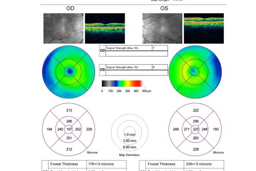 Cilioretinal artery occlusion and Ophthalmic Artery Occlusion with Relative Sparing of the Central Retinal Artery
80-year-old woman who says she was looking in the mirror, covered her right eye and noticed she could not see well out of the left eye.  That just happened yesterday.  Her last eye check was a few years ago.  She also had a carotid endarterectomy on the right side in 2006 shortly after coronary bypass surgery.  OD is 20/40, OS is 20/200.
