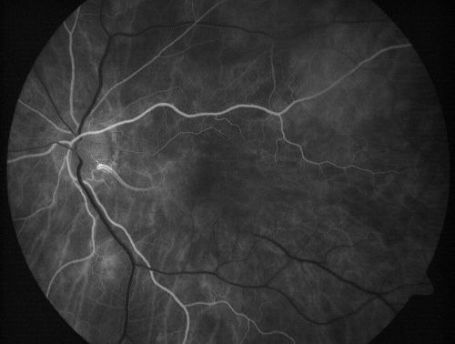 Cilioretinal artery occlusion and Ophthalmic Artery Occlusion with Relative Sparing of the Central Retinal Artery
80-year-old woman who says she was looking in the mirror, covered her right eye and noticed she could not see well out of the left eye.  That just happened yesterday.  Her last eye check was a few years ago.  She also had a carotid endarterectomy on the right side in 2006 shortly after coronary bypass surgery.  OD is 20/40, OS is 20/200.
