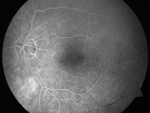Cilioretinal artery occlusion and Ophthalmic Artery Occlusion with Relative Sparing of the Central Retinal Artery
80-year-old woman who says she was looking in the mirror, covered her right eye and noticed she could not see well out of the left eye.  That just happened yesterday.  Her last eye check was a few years ago.  She also had a carotid endarterectomy on the right side in 2006 shortly after coronary bypass surgery.  OD is 20/40, OS is 20/200.
