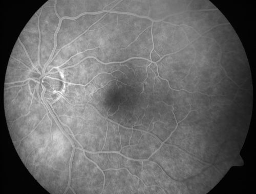 Cilioretinal artery occlusion and Ophthalmic Artery Occlusion with Relative Sparing of the Central Retinal Artery
80-year-old woman who says she was looking in the mirror, covered her right eye and noticed she could not see well out of the left eye.  That just happened yesterday.  Her last eye check was a few years ago.  She also had a carotid endarterectomy on the right side in 2006 shortly after coronary bypass surgery.  OD is 20/40, OS is 20/200.
