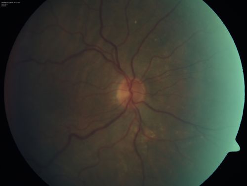 Choroidal Folds Hyperope (+5.00)
