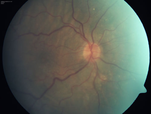 Choroidal Folds Hyperope (+5.00)
