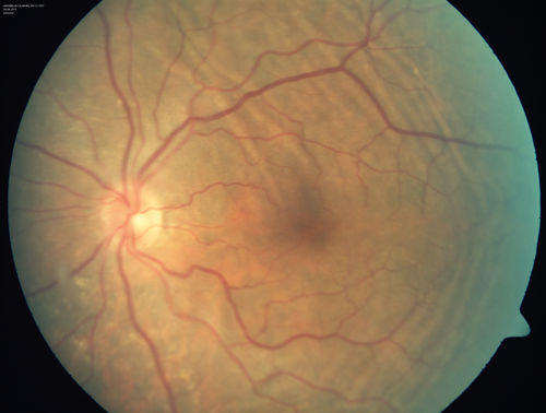 Choroidal Folds Hyperope (+5.00)
