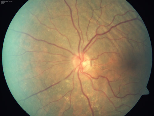 Choroidal Folds Hyperope (+5.00)
