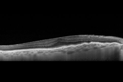 Choroidal Folds Hyperope (+5.00)
