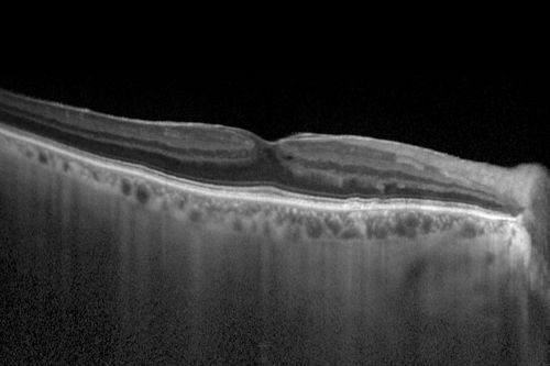 Choroidal Hemangioma - Diffuse - Enhanced Depth Imaging Spectral Domain OCT Line Scan - Normal Eye
Normal Choroidal Thickness in Right Eye

