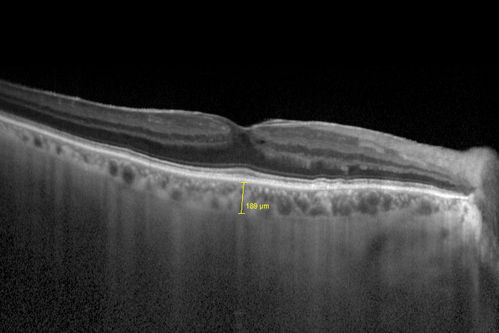 Choroidal Hemangioma - Diffuse - Enhanced Depth Imaging Spectral Domain OCT Line Scan - Normal Eye
Normal Choroidal Thickness in Right Eye
