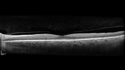 Choroidal Melanocystosis
65 year old female with normal vision.
