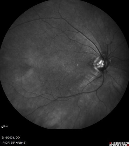 Choroidal Melanocystosis
65 year old female with normal vision.
