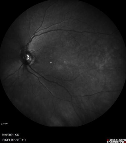 Choroidal Melanocystosis
65 year old female with normal vision.
