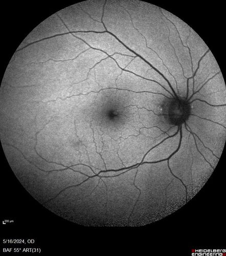 Choroidal Melanocystosis
65 year old female with normal vision.
