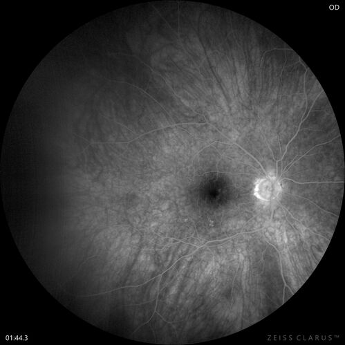Choroidal Melanocystosis
65 year old female with normal vision.
