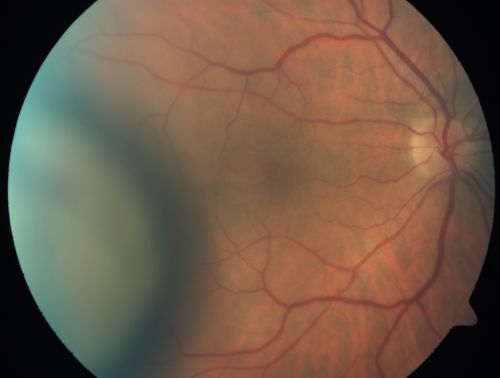 Choroidal Melanoma (Medium) Exudative Retinal Detachment 
87-year-old man noticed a new onset floater a few months ago. OD is 20/40, OS is 20/30
