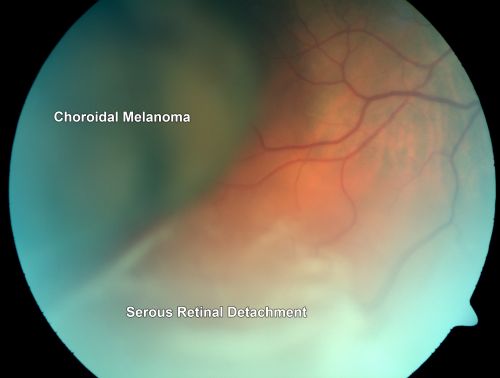 Choroidal Melanoma (Medium) Exudative Retinal Detachment 
87-year-old man noticed a new onset floater a few months ago. OD is 20/40, OS is 20/30
